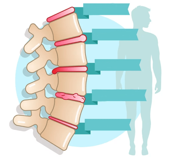ระดับของโรคทรวงอก osteochondrosis