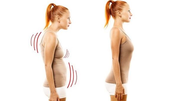 หลังตรงและท่าทางไม่ดีด้วยโรคกระดูกพรุนที่ปากมดลูก